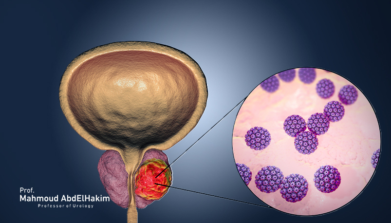 أعراض تضخم البروستاتا الخبيث
